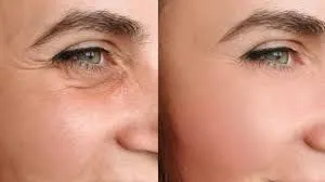 Bioestimulación cutánea en medicina estética: avances, evidencia y práctica clínica